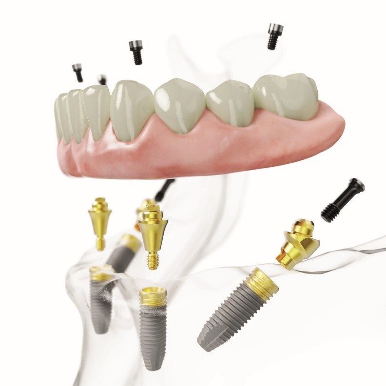 „Šypsenos akademijos“ burnos chirurgas apie efektyvų metodą: dantis atkūrėme per dešimt valandų