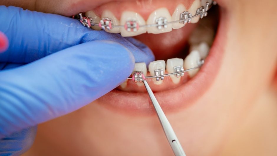 Ar jūsų vaikui reikalingas ortodontinis gydymas?