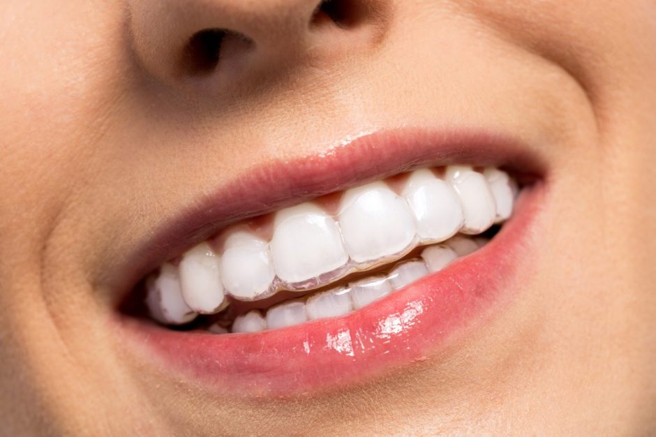Ar jūsų vaikui reikalingas ortodontinis gydymas?