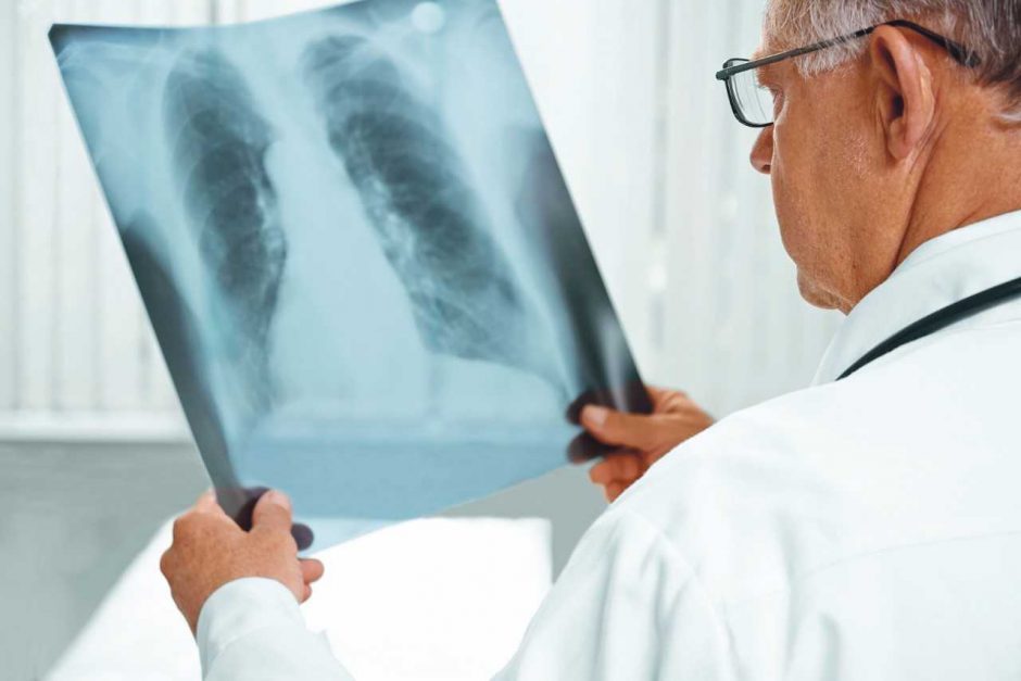 PSO: tuberkuliozė – daugiausiai gyvybių pasaulyje nusinešanti infekcinė liga