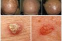 Paplitimas: penktadalis aktininės keratozės (dar vadinamos saulės keratoze, senatvine keratoze) atvejų progresuoja į plokščialąstelinę karcinomą, nuo jos dažniau kenčia šviesios, saulei jautrios odos savininkai, dažniau – vyrai.