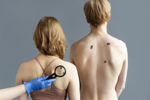 Nacionalinis vėžio institutas: sergamumas ir mirštamumas nuo melanomos didėja