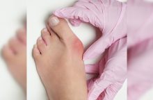 Iššokęs pėdos kauliukas: deformacija pašalinama be didelių pjūvių